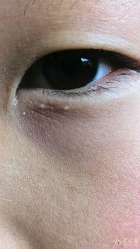 栗丘疹不痛不痒一月