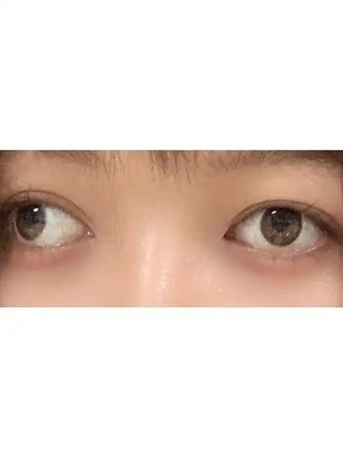 斜视矫正手术第五天