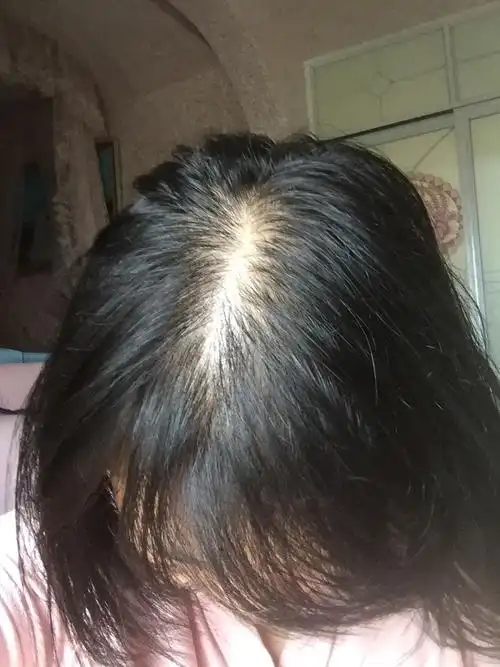 女生头顶头发少是什么体验