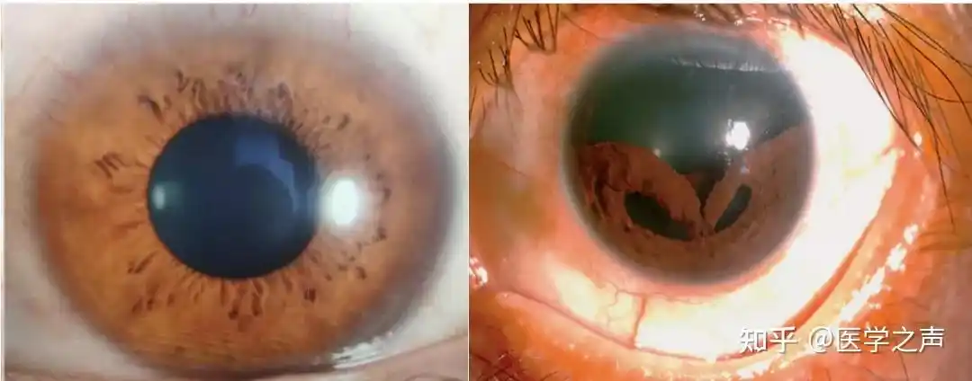 胡大夫的眼科门诊被鞭炮崩到眼睛后出现了三个瞳孔