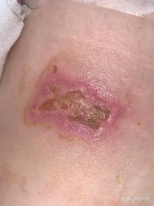 人生在世磕磕碰碰难免这次是深二度三度烧伤的护理