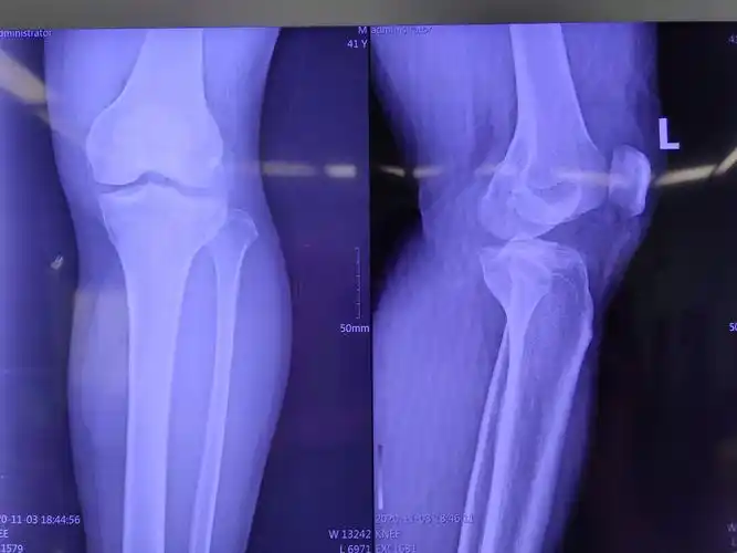 关节镜下治疗胫骨平台骨折病例展示