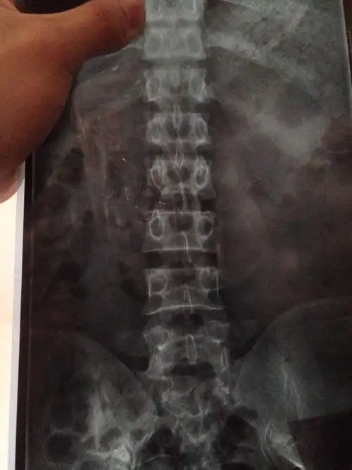 问:求大神 帮我看看 腰伤 原因蹲在地上10分钟 一下起来 就腰痛 腰就