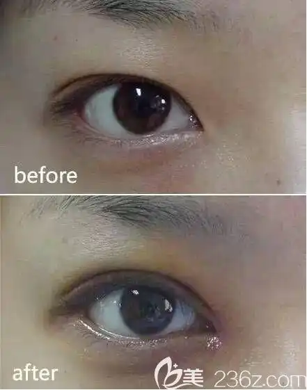 轻度内眦赘皮矫正前后对比图