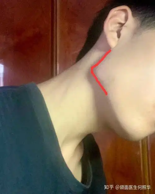 我这个下颌角是不是突出了?