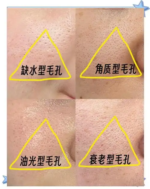 毛孔粗大?4种方法帮你轻松解决!