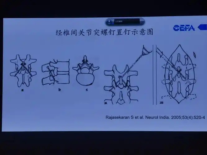 endo pin 椎板椎弓根螺钉置入技术