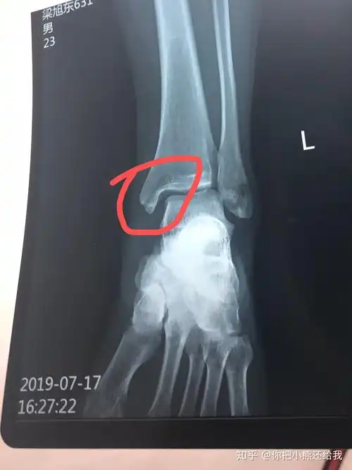 脚内踝骨折 - 知乎