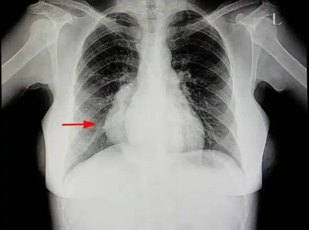 肺癌容易与4种疾病混淆,做好区分,尽早治疗很重要!