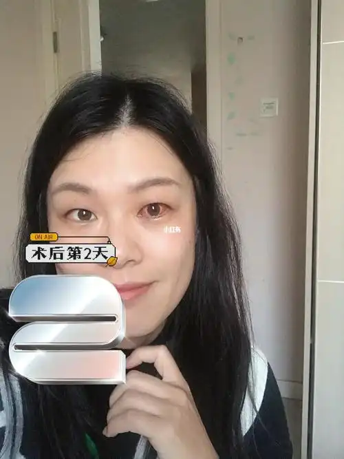 斜视手术第二天