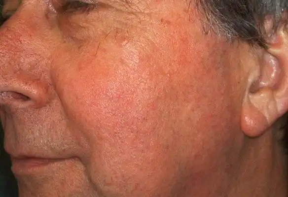 橘皮样皮肤图片45