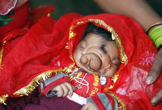 据印度媒体报道,一名印度女婴因生来脸上就长有象鼻而受到民众的朝拜.