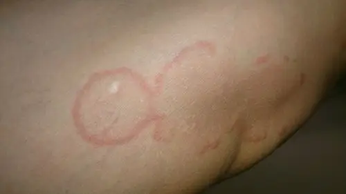 团状红斑,稍微有痒感,最大的有5mm,边缘稍微凸起.大腿 肚皮,手臂上有.