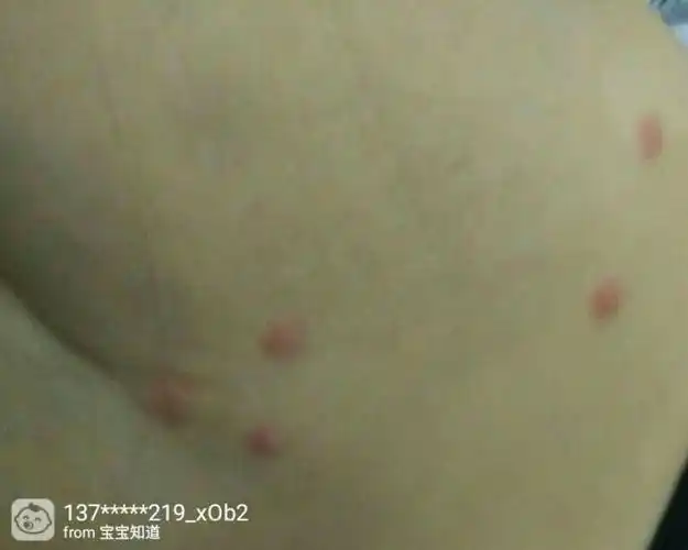 睾丸上有疙瘩,在线,急