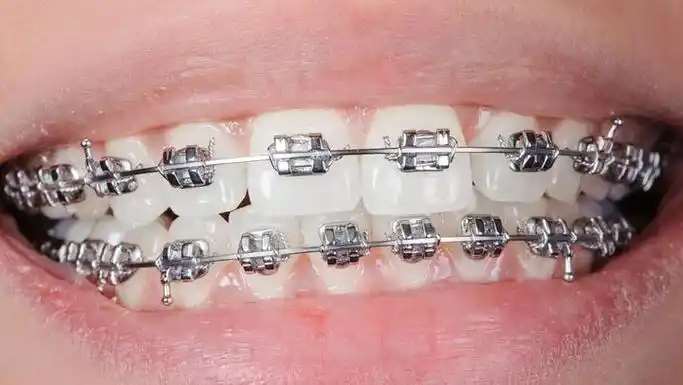 地包天做了牙齿矫正后改变能有多大?青少年可以做矫正吗?