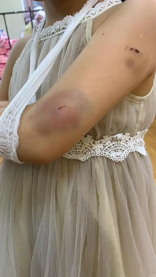 晚餐时间,只因嫌弃楼上"动静大",楼下邻居推门而入暴打全家,受伤的楼