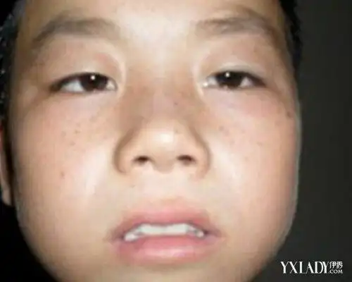 儿童为什么会长雀斑