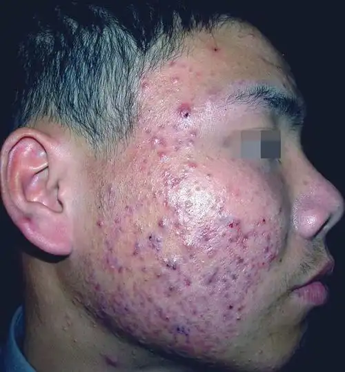 如果不是很严重,就随它好叻,你还是初三 ,有青春痘 再正常不过了,其次