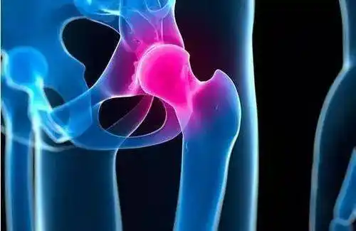 人,一旦不慎摔跤后导致了髋关节疼痛,这种疼痛多半考虑可能是股骨粗隆