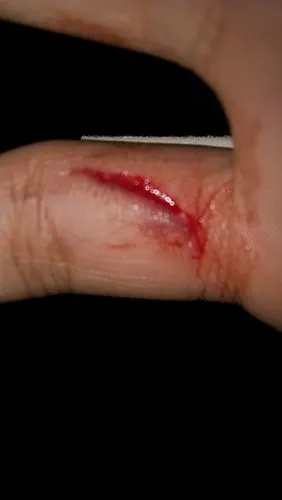 手被划破怎么处理?