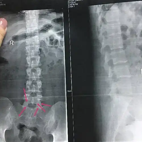 展开全部 第五腰椎两侧椎板象有骨折? 最好ct排除. 骨折引起侧弯?