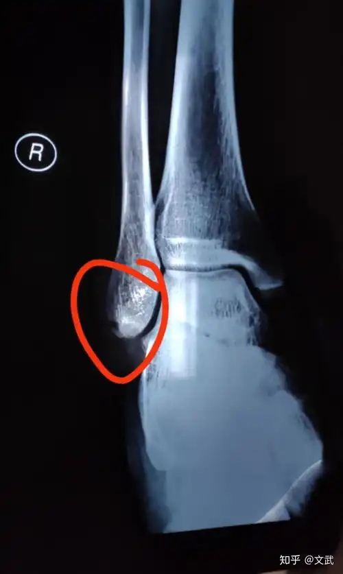 脚踝腓骨撕脱性骨折多久可以下地走路