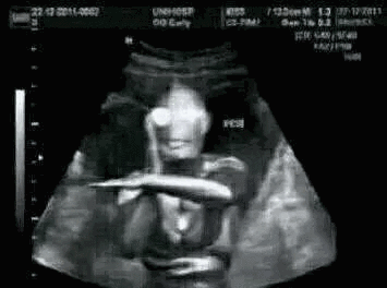 我怀孕了套路表情包搞笑b超图