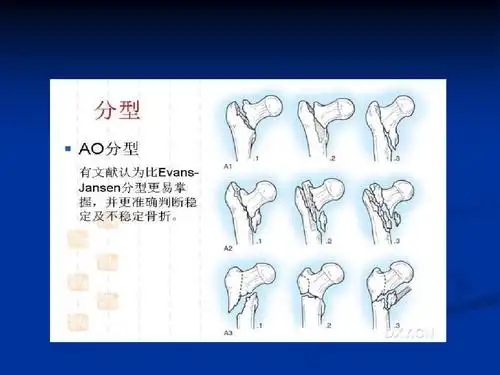 股骨粗隆间骨折