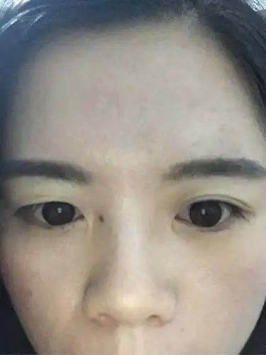 20岁的大小眼少女,眼睛一单一双,单眼皮的那只上眼皮从小到大都有一道