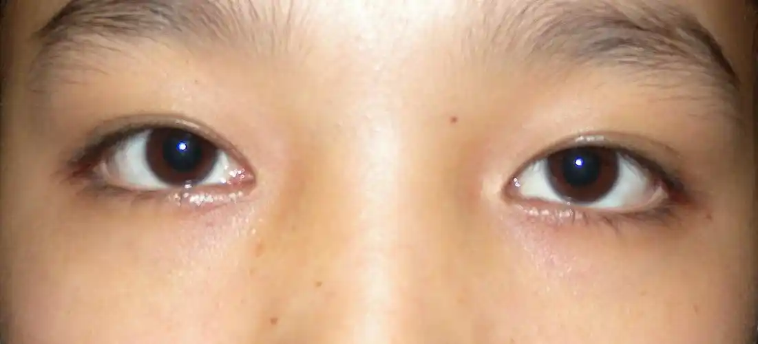 我做过的典型的斜视病例图片