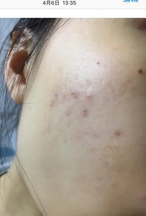 【有图慎入】关于痘痘烂脸的心得(11月5日更)