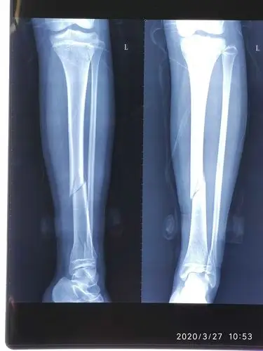儿童胫腓骨骨折的治疗_胫腓骨骨折_治疗方式_日常注意事项 - 好大夫