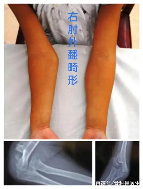 浅谈儿童肱骨外髁骨折