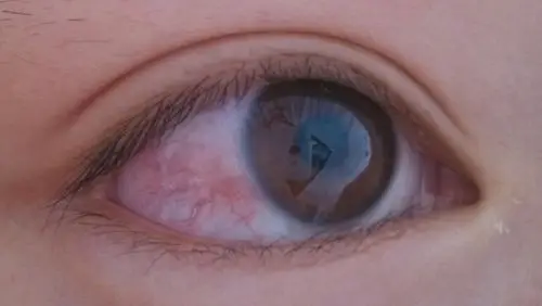 眼白红了一块