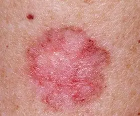 地图状牜皮癣的临床症状