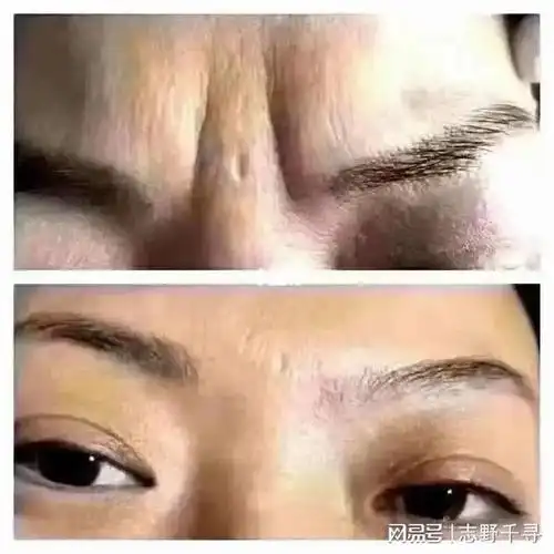 国内去除重度悬针纹最好的医院哪个方法比较好呢