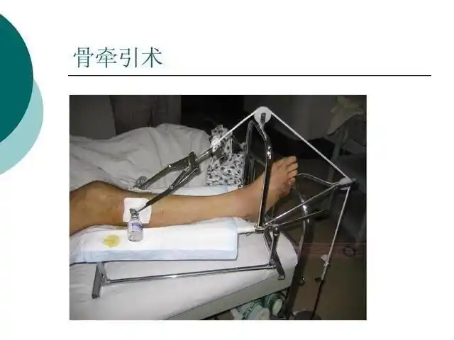 入院后给予左胫骨结节骨牵引,待患者患肢消肿后,宋俊峰,为患者行闭合