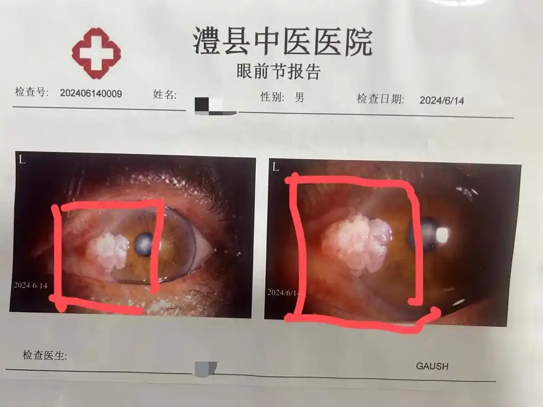 眼睛表面长疙瘩,小心恶性肿瘤!