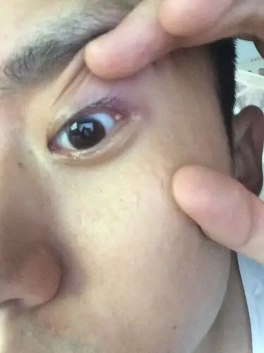 我长了针眼,现在眼角上已经起了白点了.需要去医院切开吗?