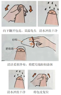 具体方法包括:治疗与预防2包皮龟头炎是小儿泌尿外科最常见的疾病之一