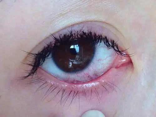 肝脏好不好,眼睛最先"出卖"你!4事常做,肝病"不战而败"