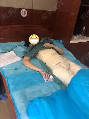 吸脂瘦腰腹术后2天_吸脂术后2天_瘦腰腹术后2天_美体塑形术后2天_樱桃