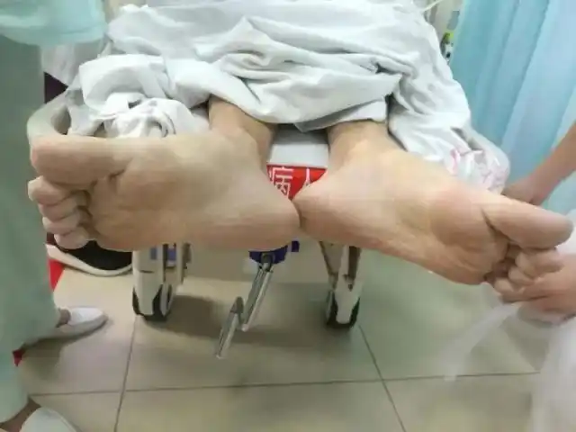 患者胸口凹陷,是漏斗胸表现.