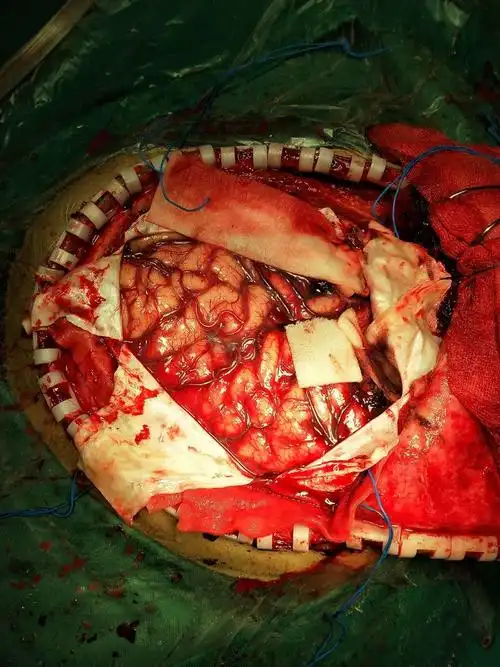 重型颅脑损伤并脑疝病人开颅手术