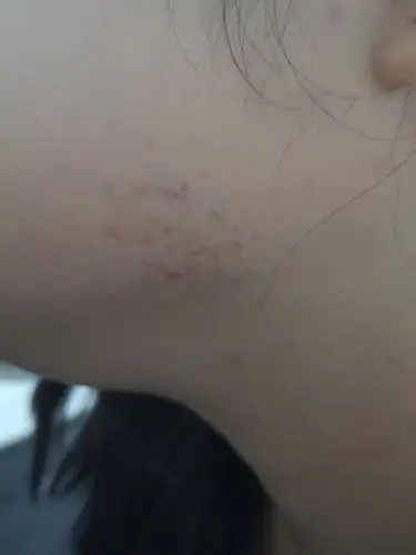 下巴长红色点点,是什么原因.不痛不痒