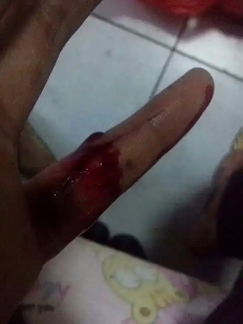 这样的伤口需要去医院吗?