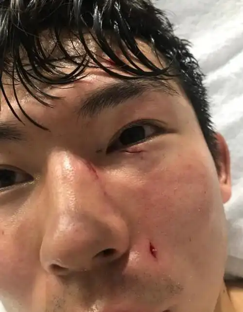 杨世元脸上伤痕累累