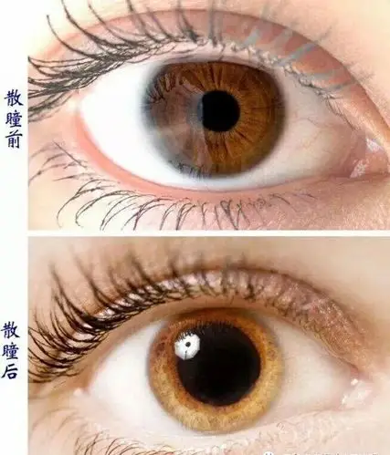 孩子验光必须要散瞳吗?"这篇文章告诉你答案