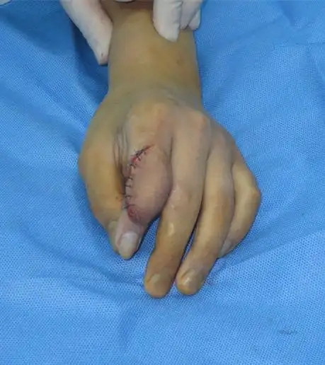 左手食指近侧指间关节陈旧性脱位畸形整形术 - 好大夫在线