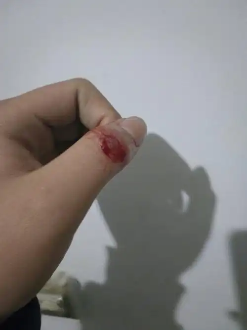 手被菜刀割了一下 割了皮 还有一些肉.但是没掉下来.需要打破伤风么.